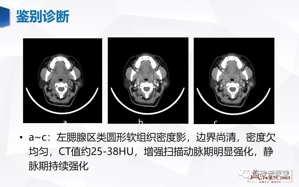 【病例】腮腺肿瘤—腮腺腺淋巴瘤1例CT及MR-15