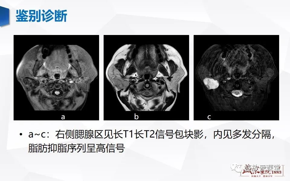 【病例】腮腺肿瘤—腮腺腺淋巴瘤1例CT及MR-17