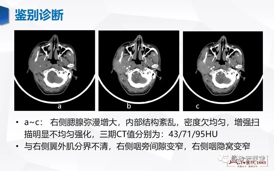 【病例】腮腺肿瘤—腮腺腺淋巴瘤1例CT及MR-20