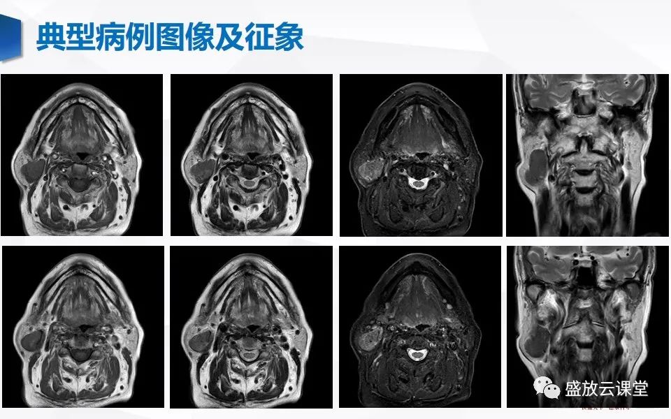 【病例】腮腺肿瘤—腮腺腺淋巴瘤1例CT及MR-2