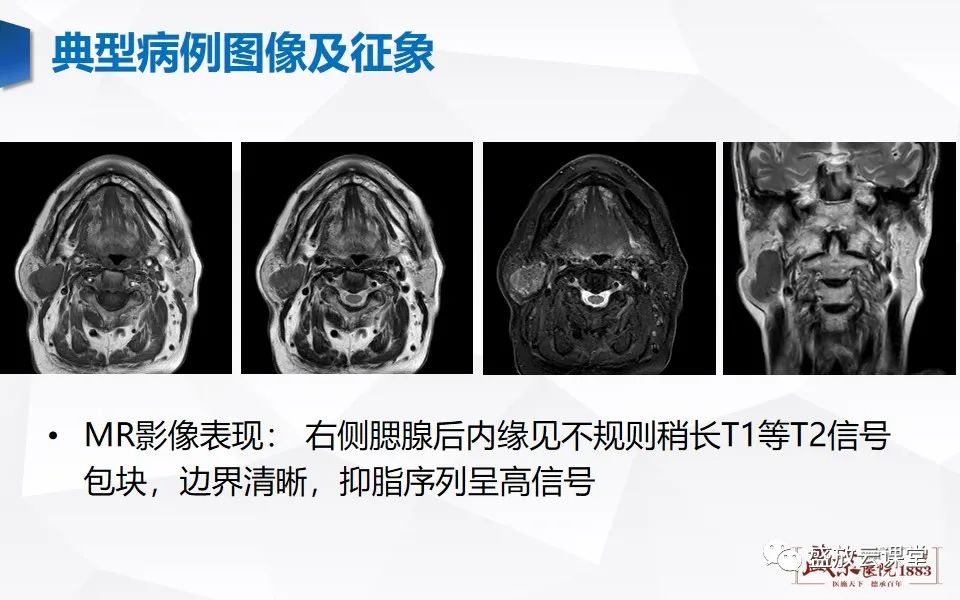 【病例】腮腺肿瘤—腮腺腺淋巴瘤1例CT及MR-1