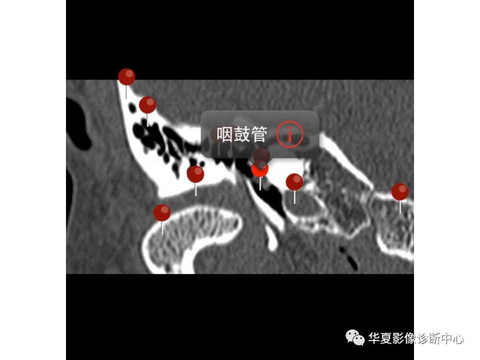 【PPT】耳的影像解剖及常见疾病诊断-7