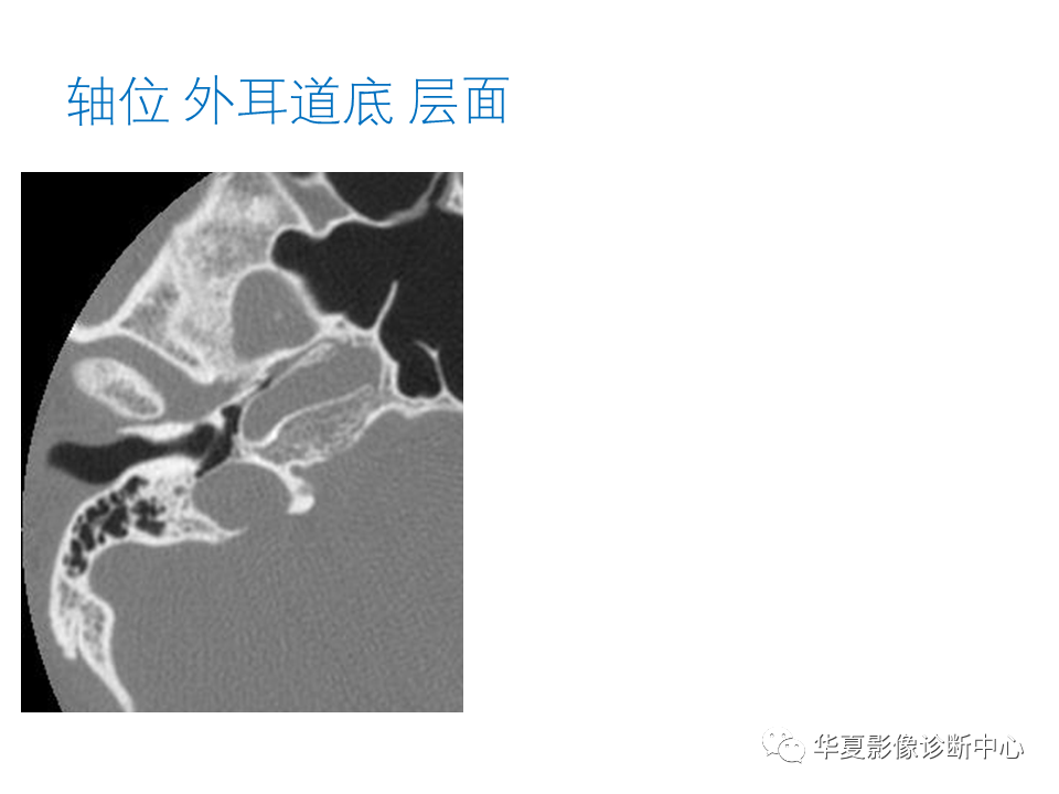 【PPT】耳的影像解剖及常见疾病诊断-14