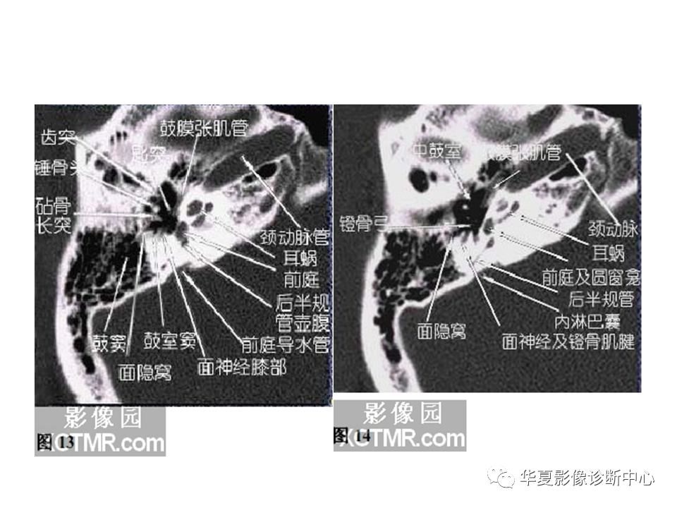 【PPT】耳的影像解剖及常见疾病诊断-23