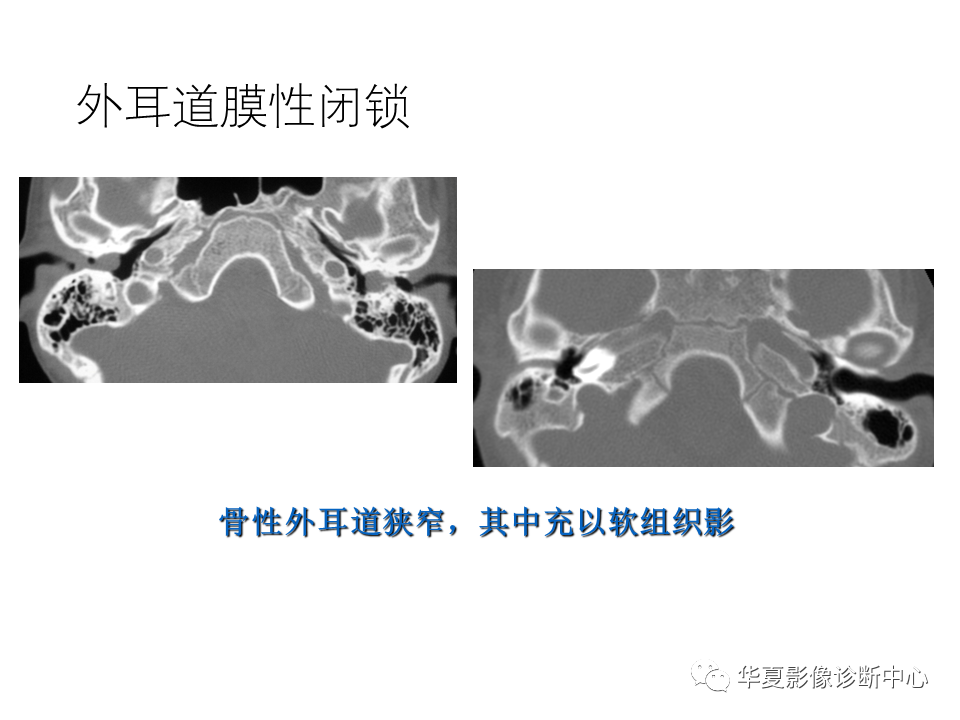 【PPT】耳的影像解剖及常见疾病诊断-19