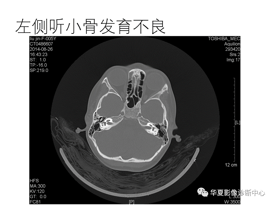 【PPT】耳的影像解剖及常见疾病诊断-21