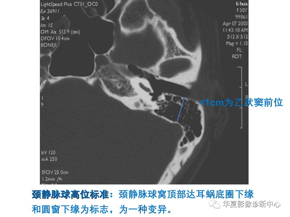 【PPT】耳的影像解剖及常见疾病诊断-33