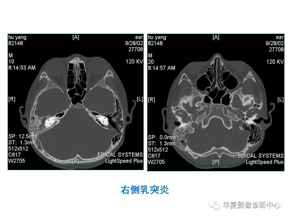 【PPT】耳的影像解剖及常见疾病诊断-36