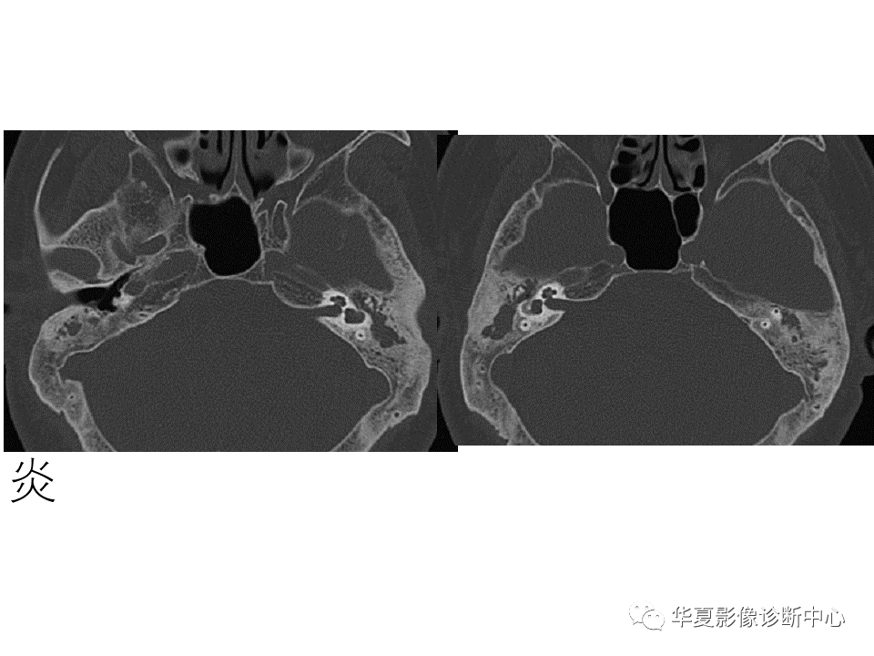 【PPT】耳的影像解剖及常见疾病诊断-40