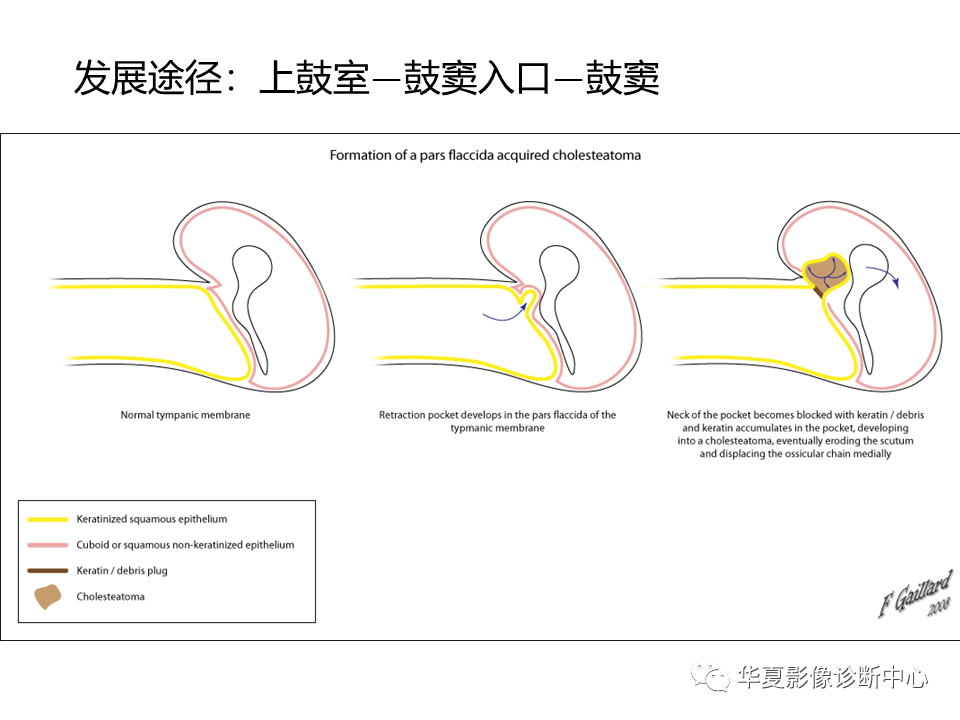 【PPT】耳的影像解剖及常见疾病诊断-47