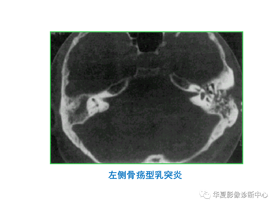 【PPT】耳的影像解剖及常见疾病诊断-43