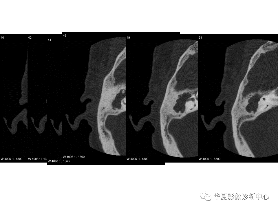 【PPT】耳的影像解剖及常见疾病诊断-53