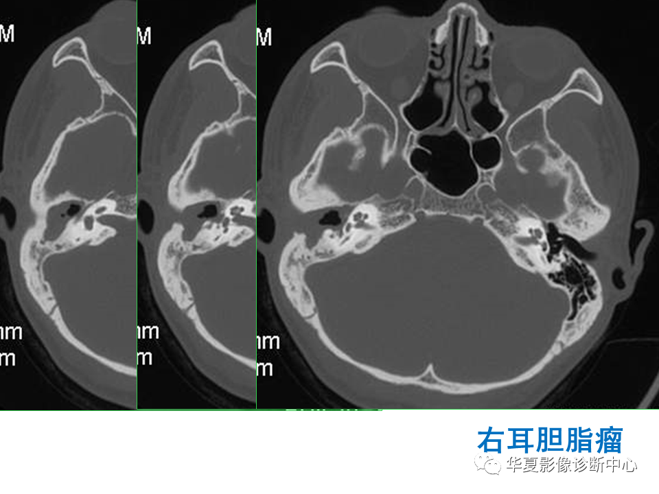 【PPT】耳的影像解剖及常见疾病诊断-55