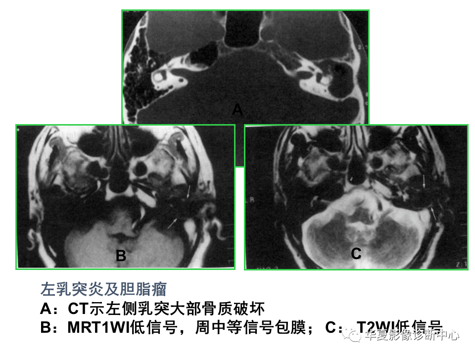 【PPT】耳的影像解剖及常见疾病诊断-57