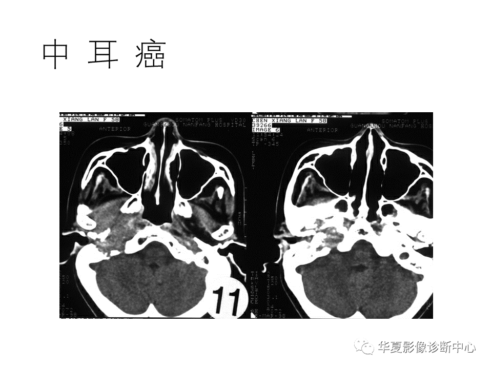 【PPT】耳的影像解剖及常见疾病诊断-61