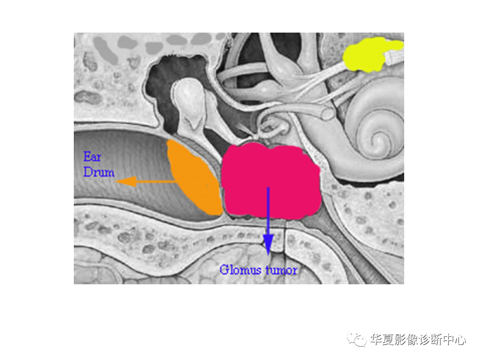 【PPT】耳的影像解剖及常见疾病诊断-65