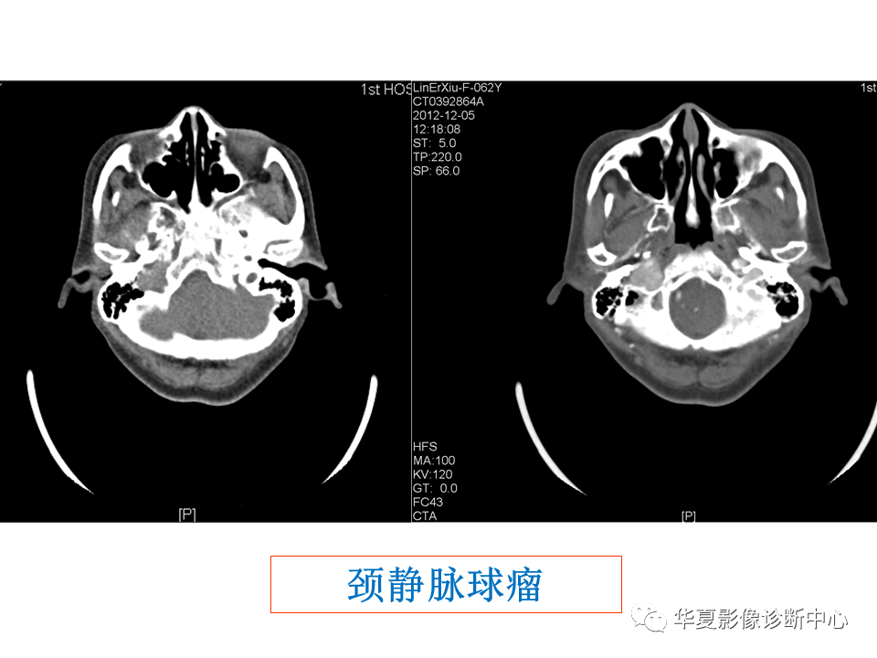 【PPT】耳的影像解剖及常见疾病诊断-68
