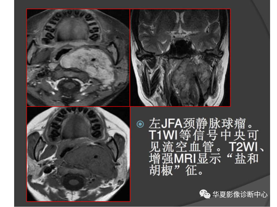 【PPT】耳的影像解剖及常见疾病诊断-70