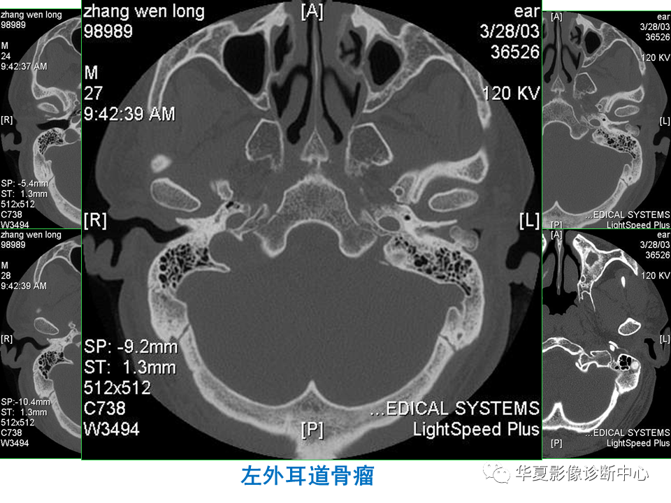 【PPT】耳的影像解剖及常见疾病诊断-75