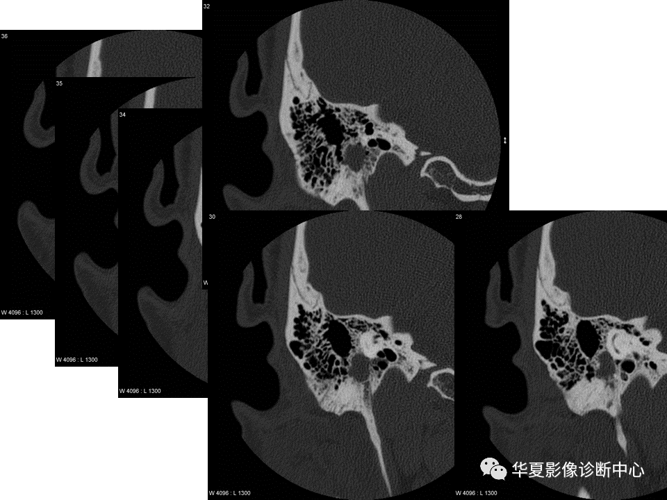 【PPT】耳的影像解剖及常见疾病诊断-85