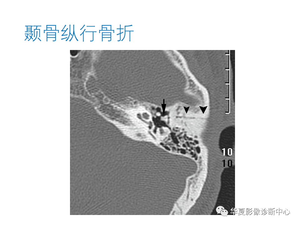 【PPT】耳的影像解剖及常见疾病诊断-87