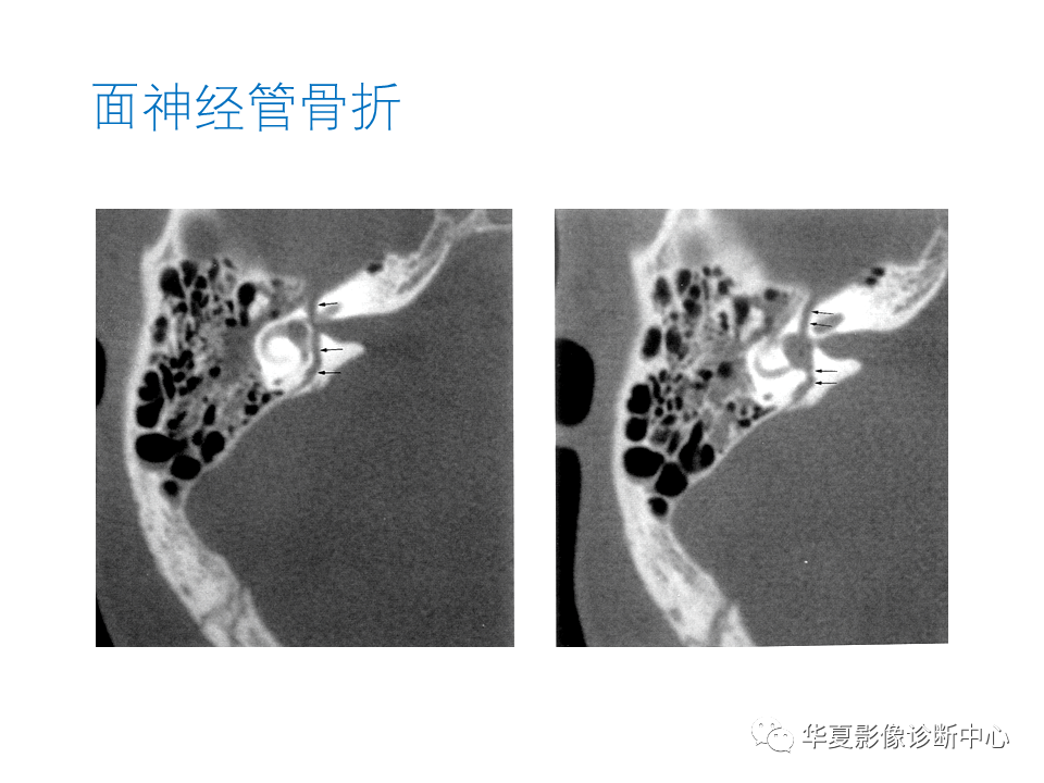 【PPT】耳的影像解剖及常见疾病诊断-88