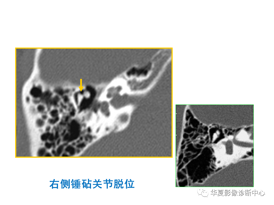 【PPT】耳的影像解剖及常见疾病诊断-89