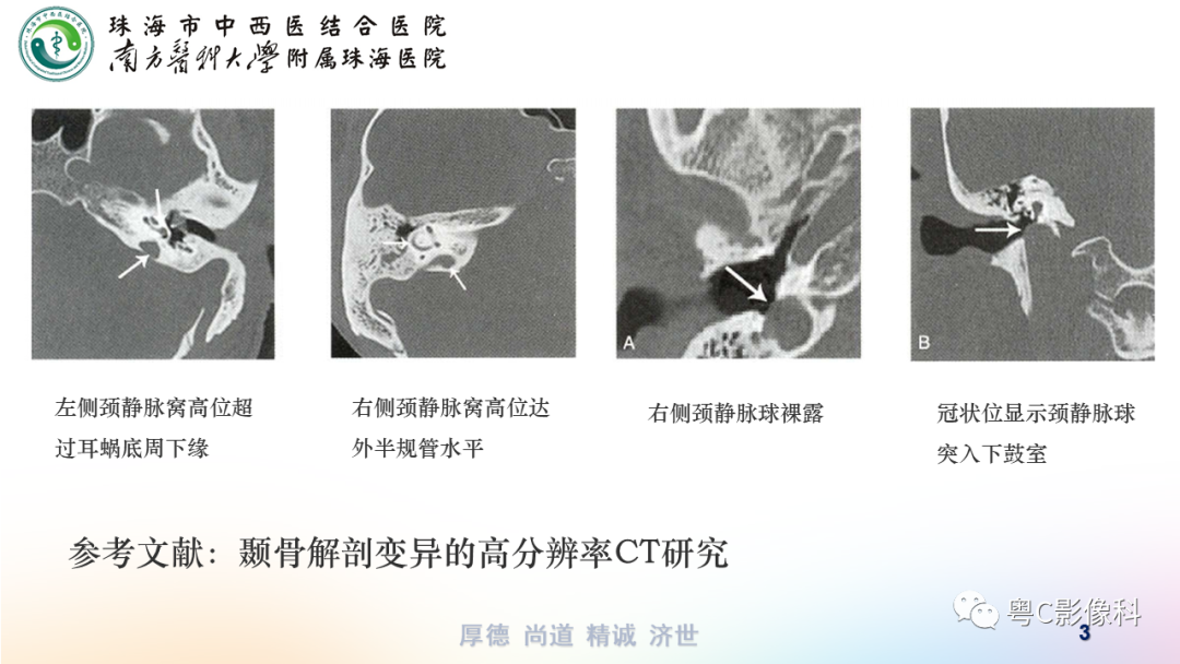 【PPT】颞骨CT检查容易忽略的两个问题-3