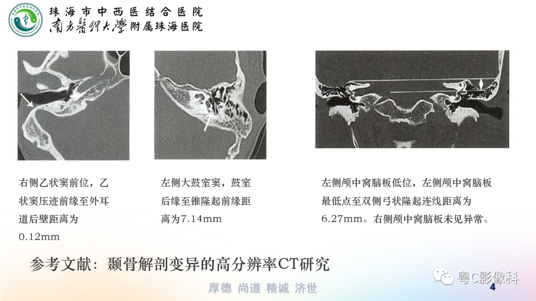 【PPT】颞骨CT检查容易忽略的两个问题-4