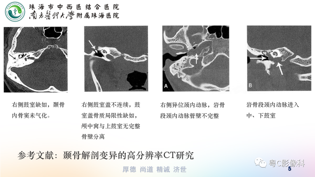 【PPT】颞骨CT检查容易忽略的两个问题-5