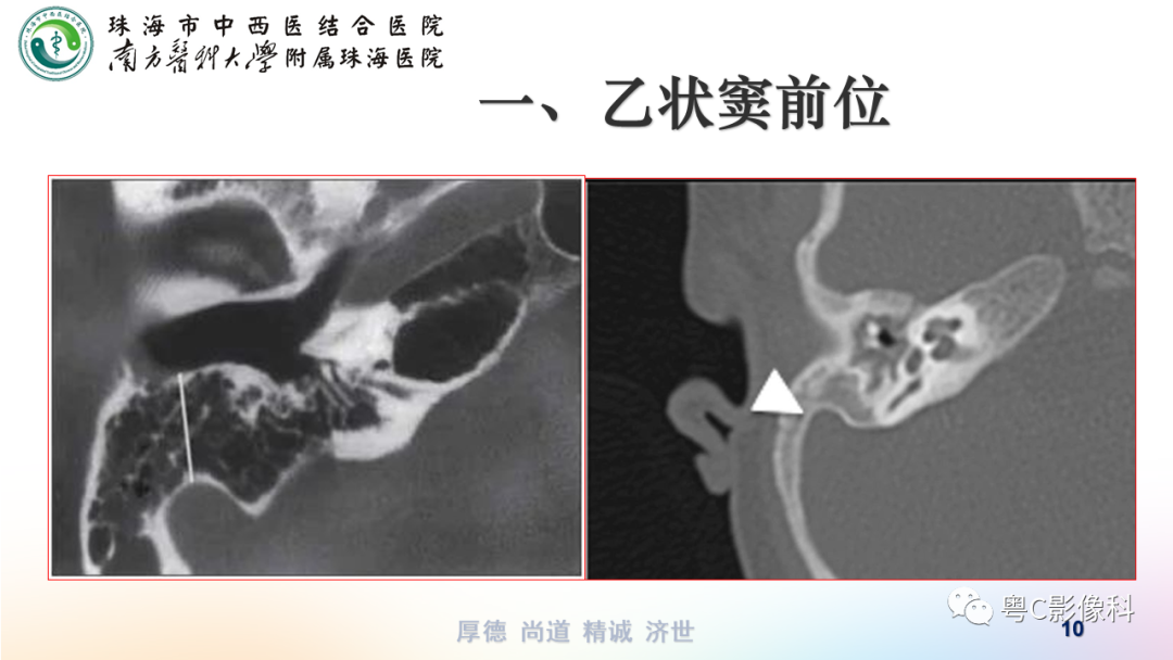 【PPT】颞骨CT检查容易忽略的两个问题-10