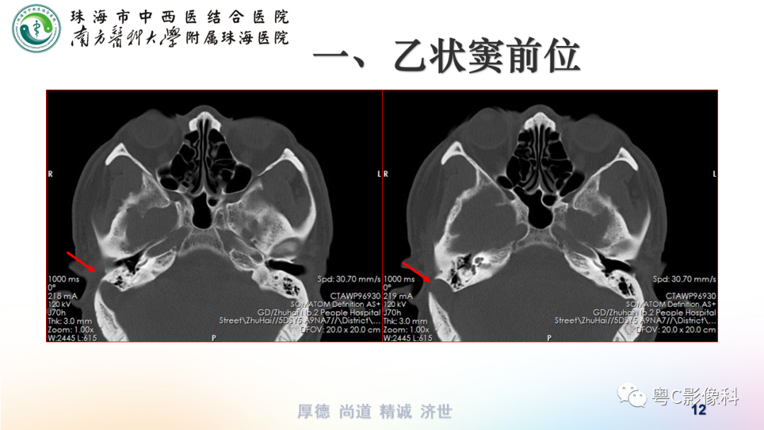【PPT】颞骨CT检查容易忽略的两个问题-12
