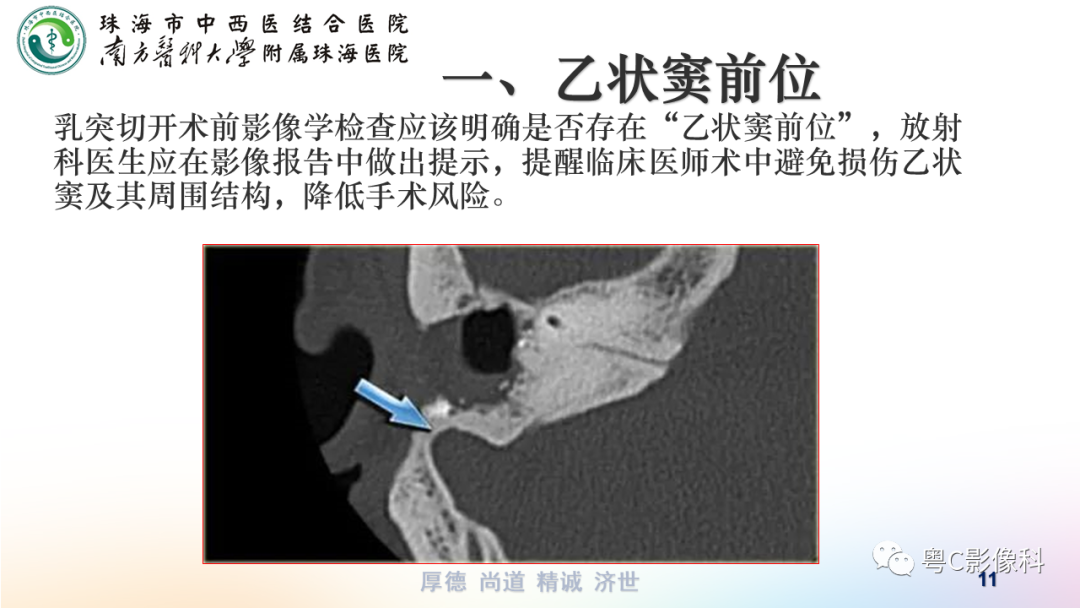 【PPT】颞骨CT检查容易忽略的两个问题-11