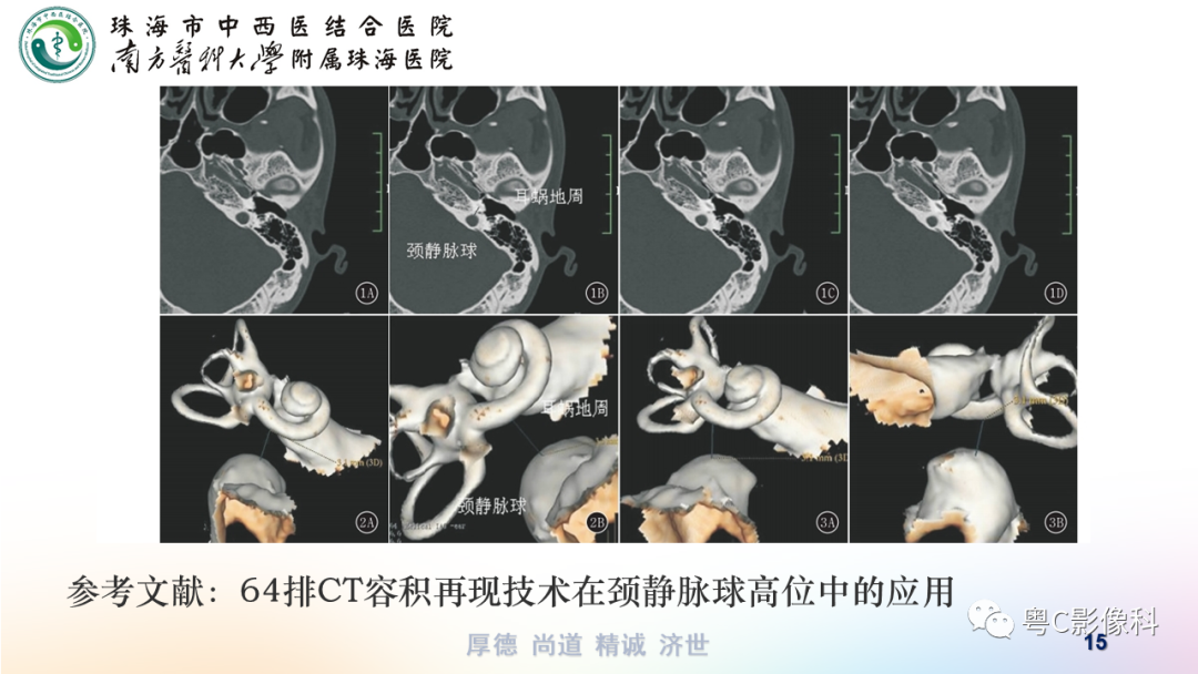 【PPT】颞骨CT检查容易忽略的两个问题-15