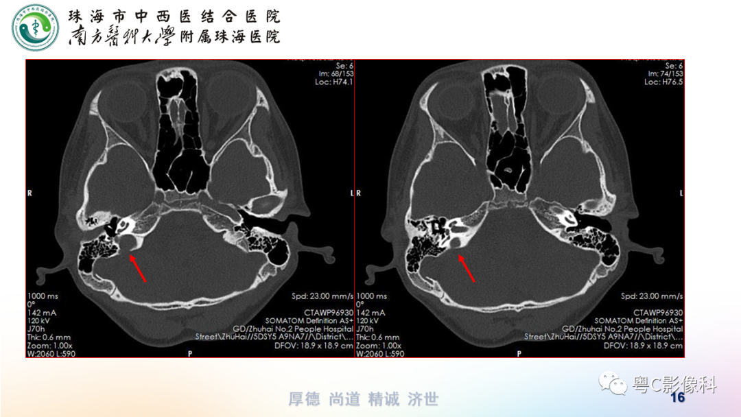 【PPT】颞骨CT检查容易忽略的两个问题-16