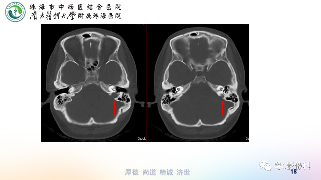 【PPT】颞骨CT检查容易忽略的两个问题-18