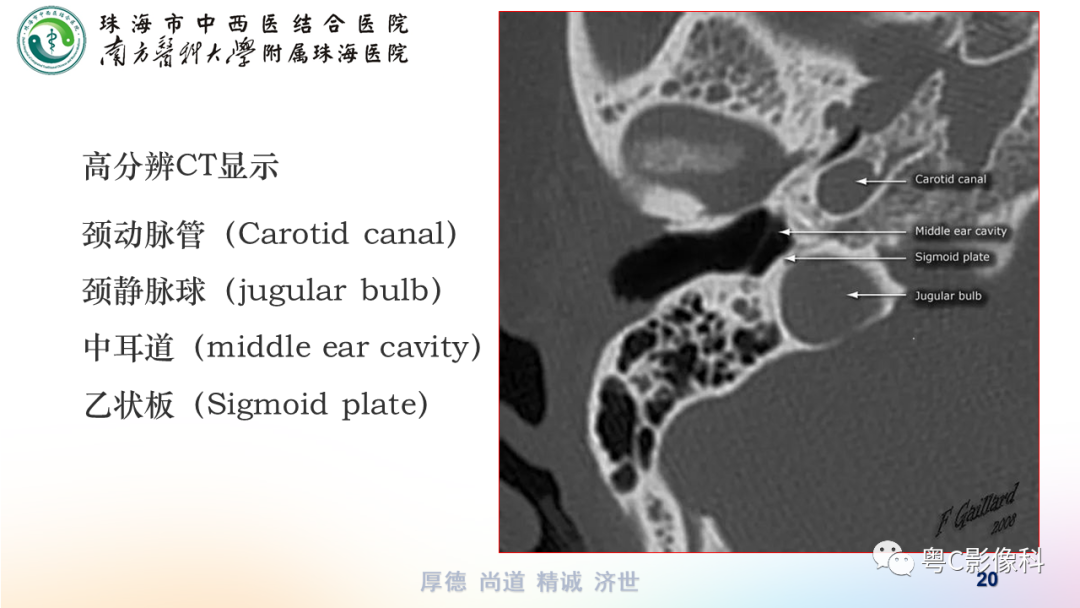 【PPT】颞骨CT检查容易忽略的两个问题-20