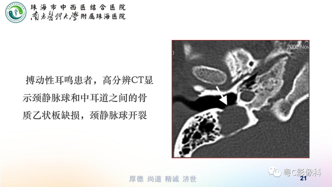 【PPT】颞骨CT检查容易忽略的两个问题-21