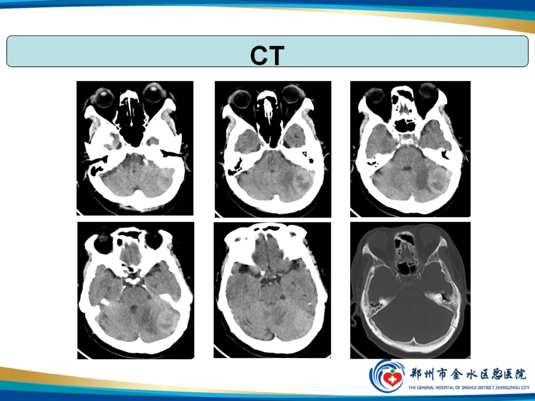 【PPT】非典型脑膜瘤影像学诊断-3