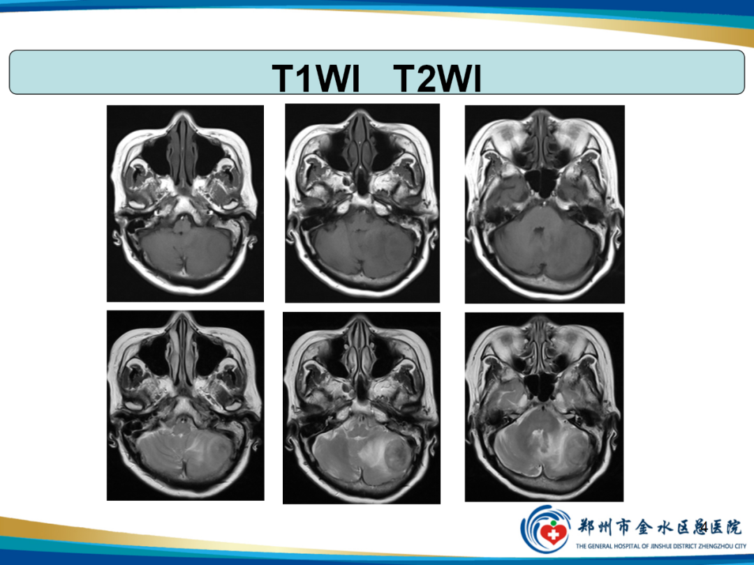 【PPT】非典型脑膜瘤影像学诊断-4