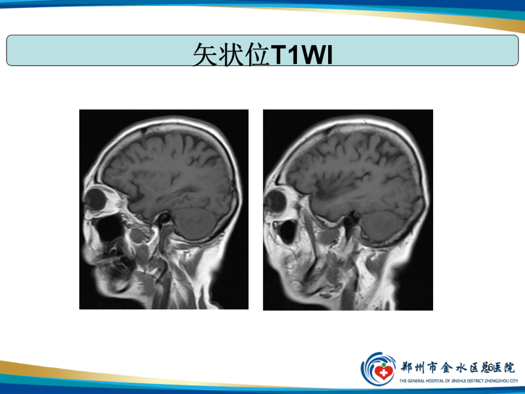 【PPT】非典型脑膜瘤影像学诊断-6