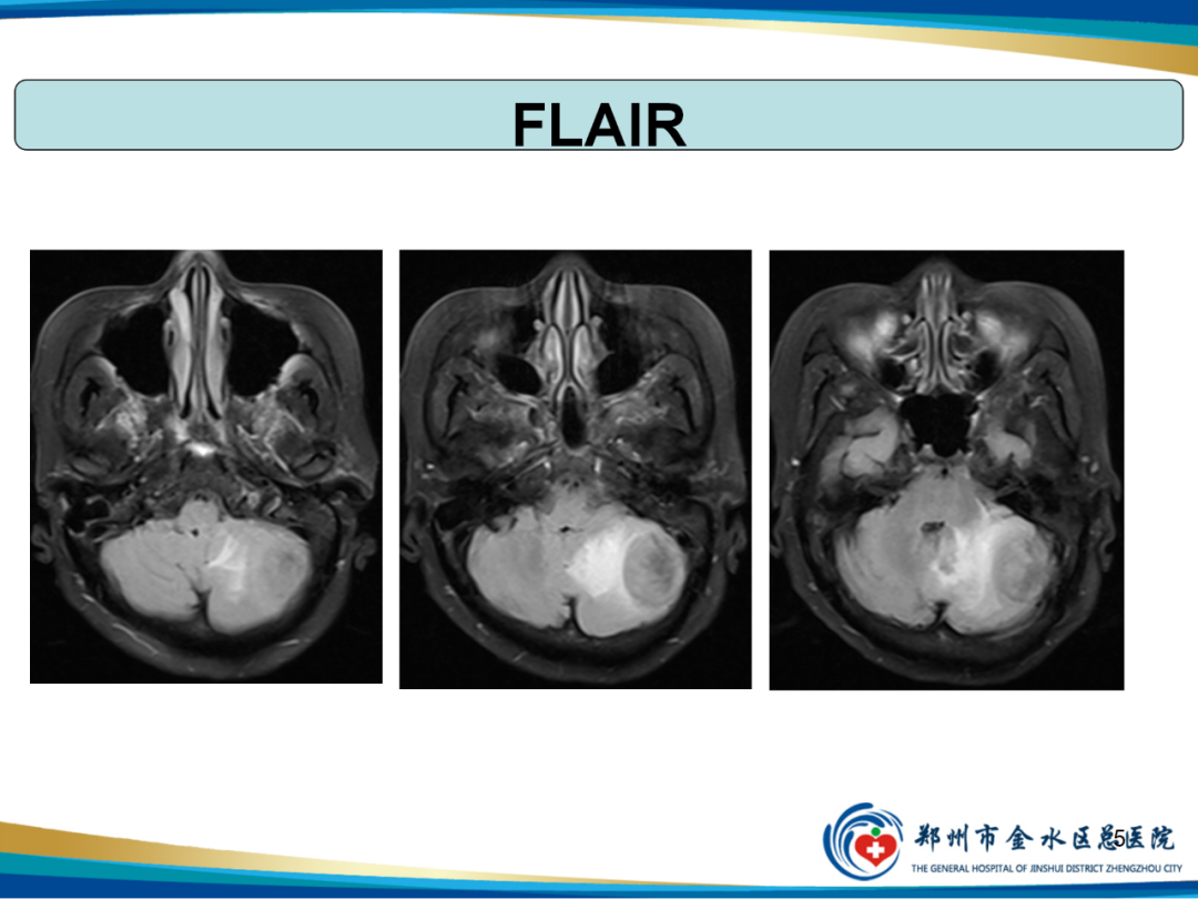 【PPT】非典型脑膜瘤影像学诊断-5