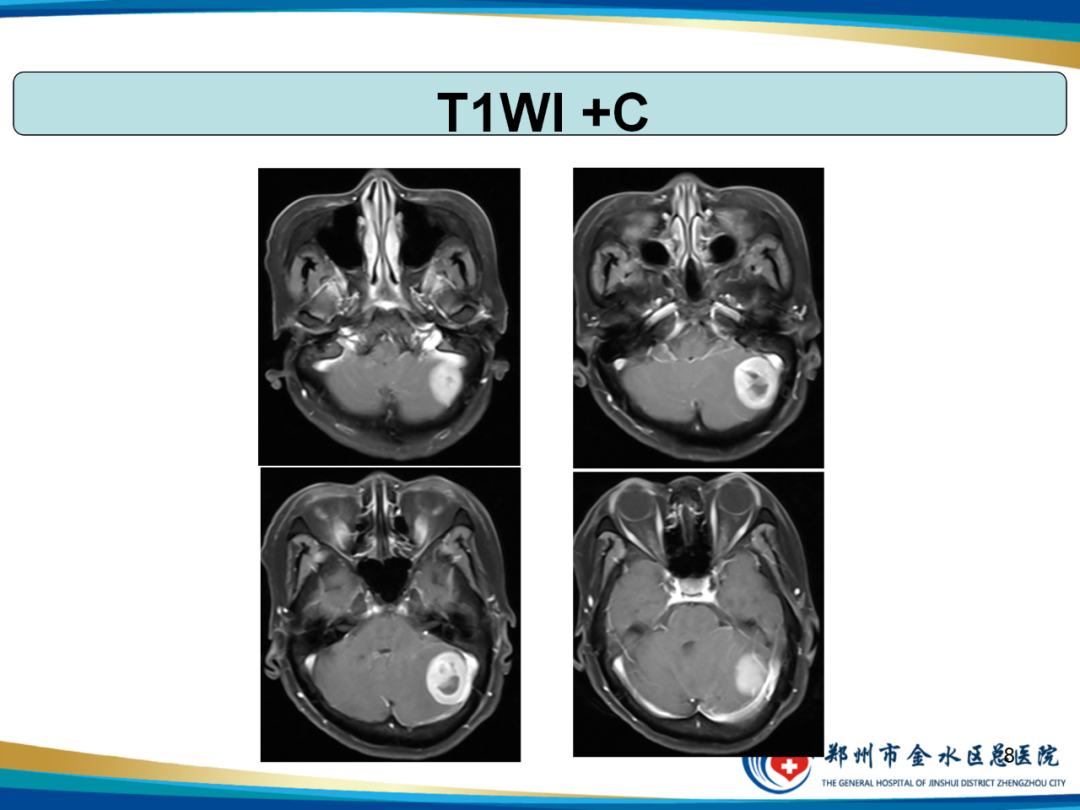 【PPT】非典型脑膜瘤影像学诊断-8