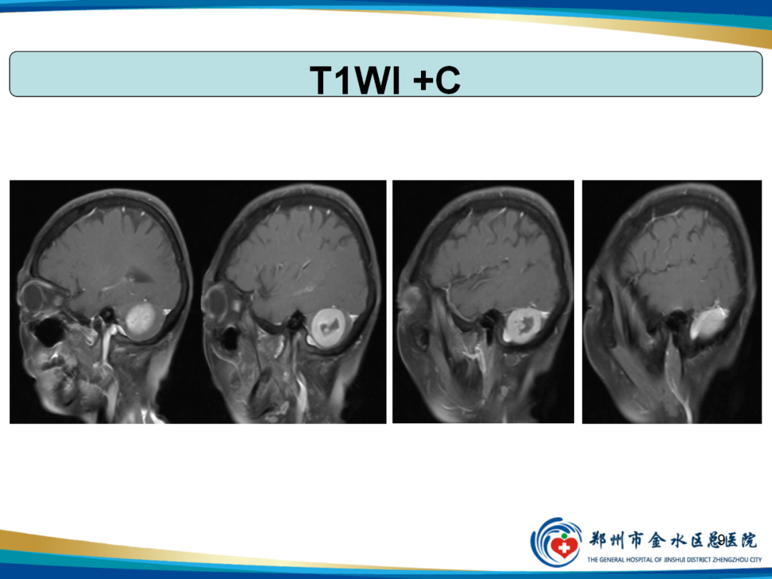 【PPT】非典型脑膜瘤影像学诊断-9