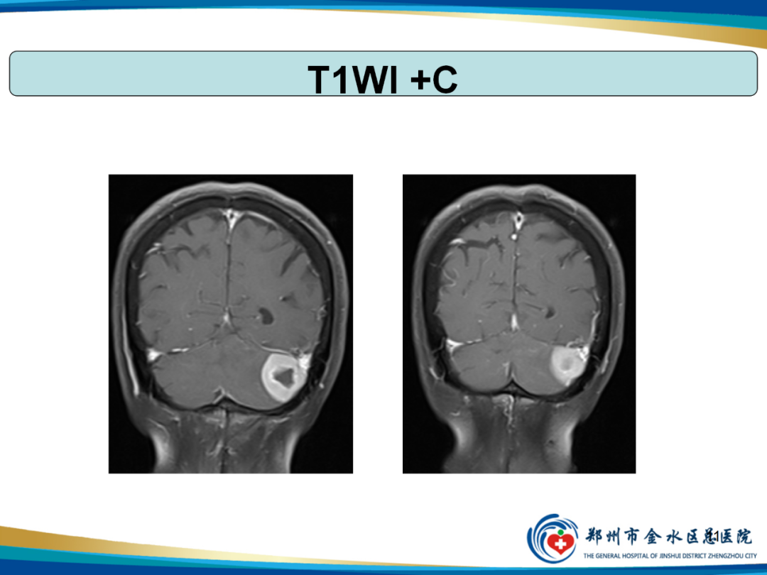 【PPT】非典型脑膜瘤影像学诊断-11