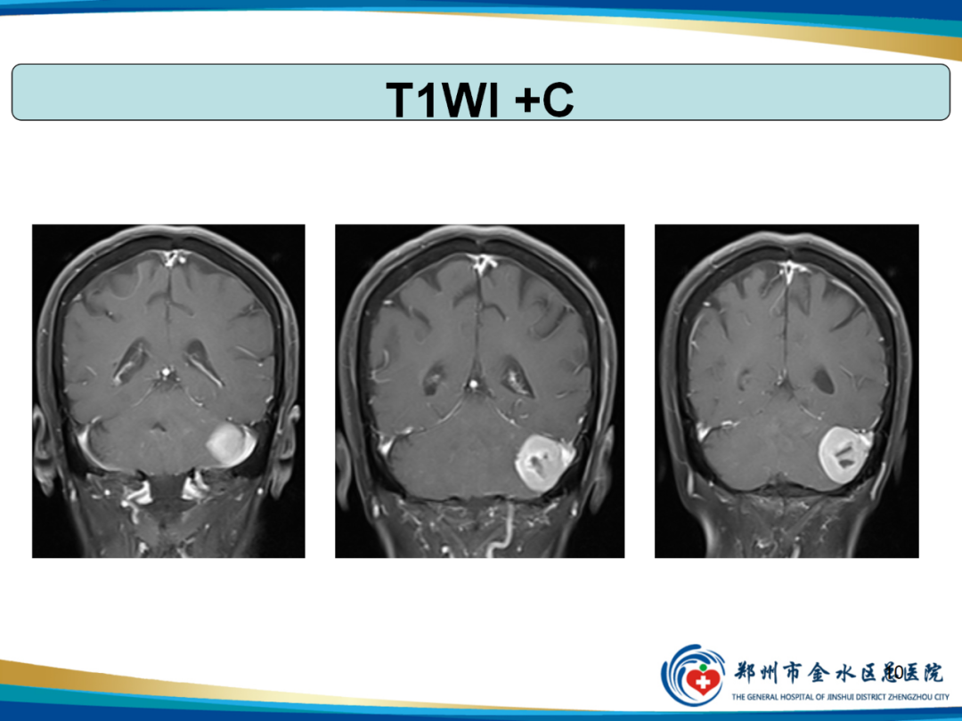 【PPT】非典型脑膜瘤影像学诊断-10