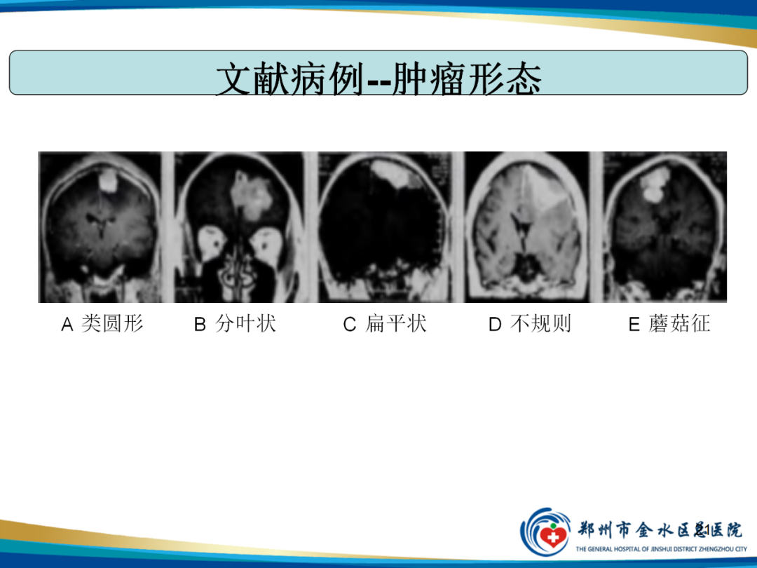 【PPT】非典型脑膜瘤影像学诊断-21