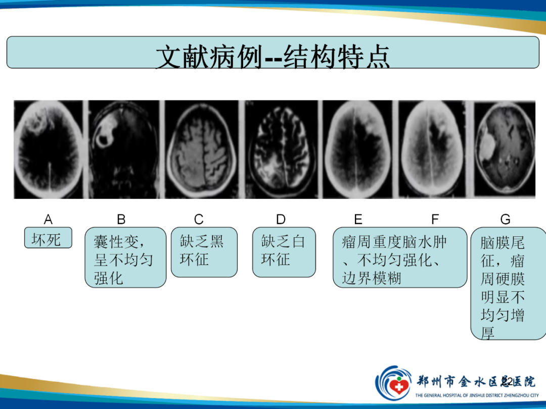 【PPT】非典型脑膜瘤影像学诊断-22