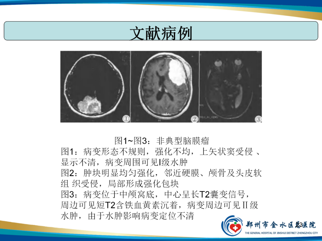 【PPT】非典型脑膜瘤影像学诊断-23