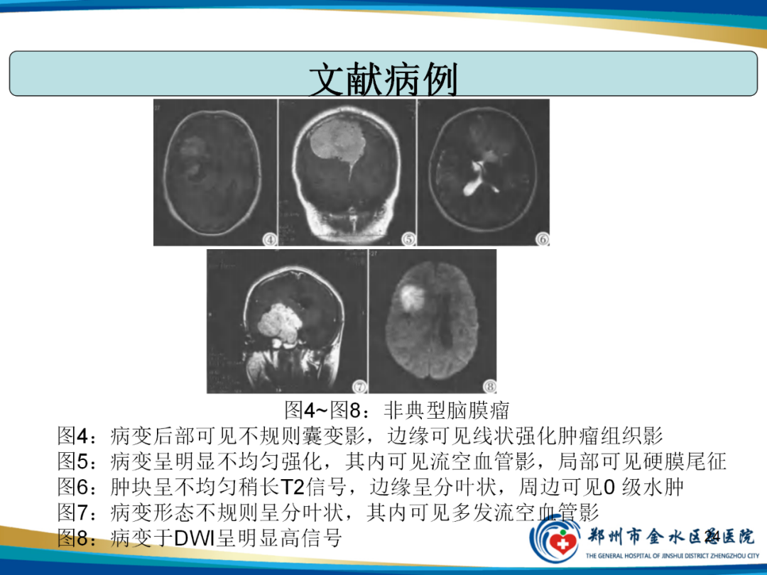 【PPT】非典型脑膜瘤影像学诊断-24